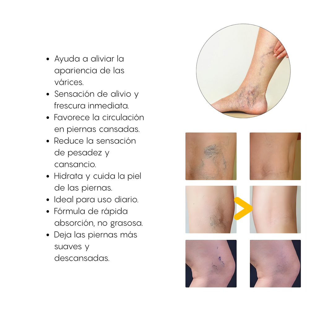 Crema Para Varices
