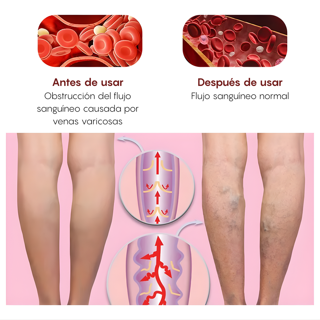 Crema Para Varices